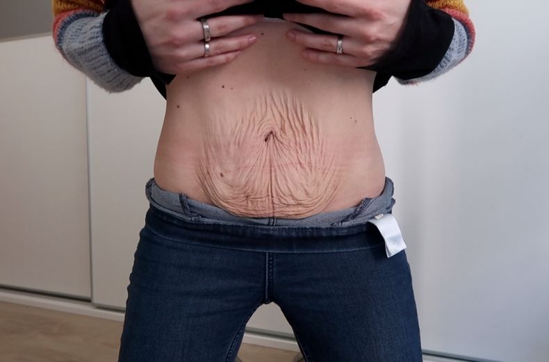 barriga postparto después de embarazo gemelar